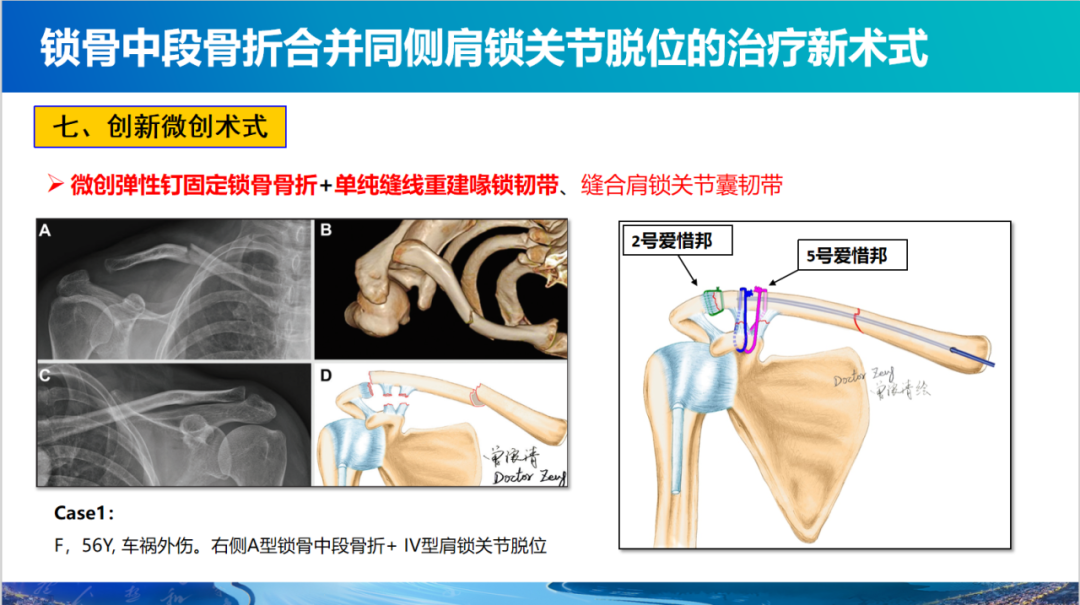 锁骨中段骨折合并同侧肩锁关节脱位新术式：弹性髓内钉+喙锁韧带重建、关节囊缝合