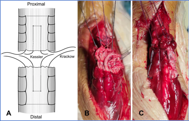 【手术技术】切开修复技术治疗急性跟腱断裂