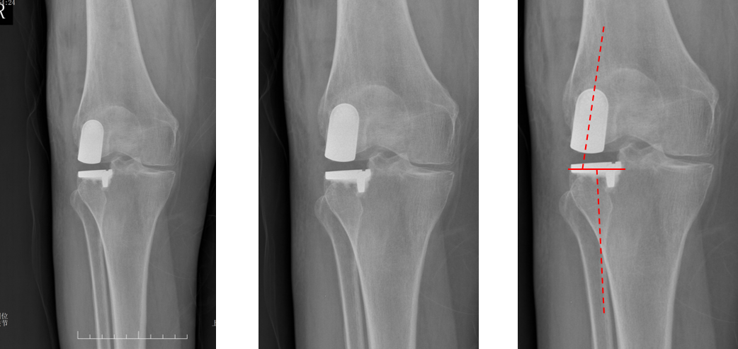 【读懂单髁】从读懂X-ray开始：固定平台单髁假体(LINK®