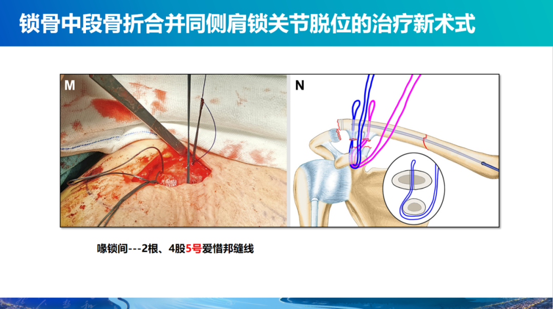 锁骨中段骨折合并同侧肩锁关节脱位新术式：弹性髓内钉+喙锁韧带重建、关节囊缝合