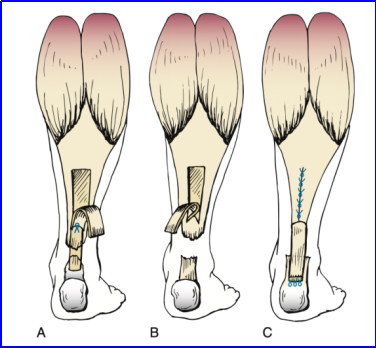 ​图文并茂：慢性跟腱断裂的最新治疗进展