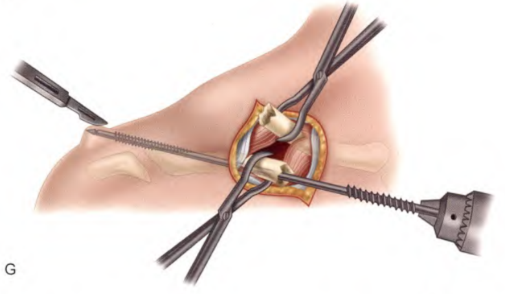 锁骨骨折：从分型到治疗的超全讲解，一文搞定！