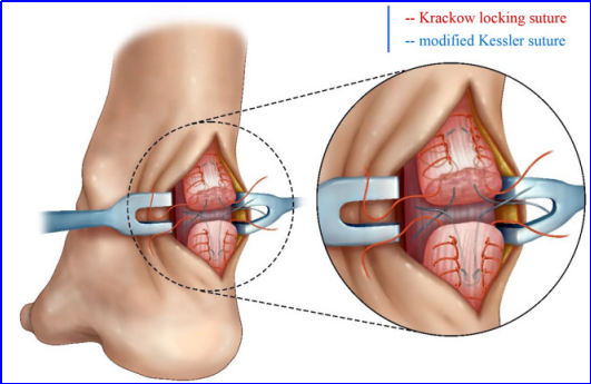 【手术技术】切开修复技术治疗急性跟腱断裂