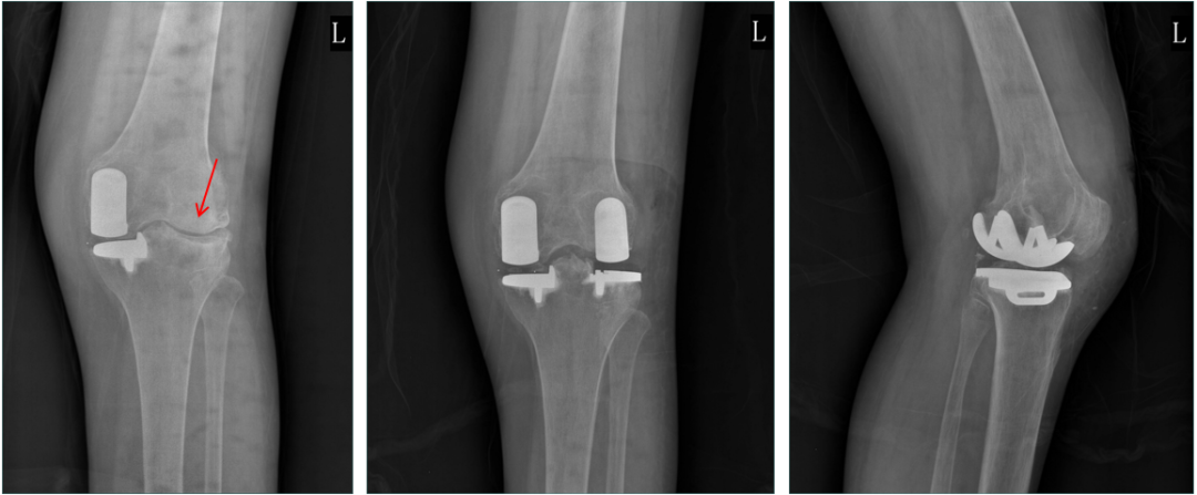 【读懂单髁】从读懂X-ray开始：固定平台单髁假体(LINK®