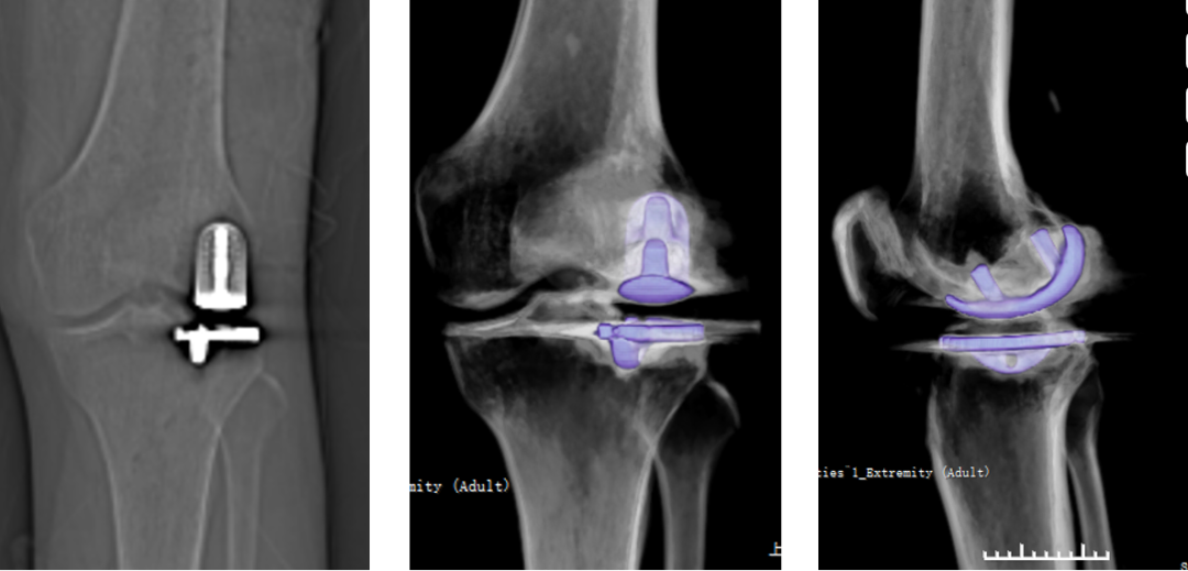 【读懂单髁】从读懂X-ray开始：固定平台单髁假体(LINK®