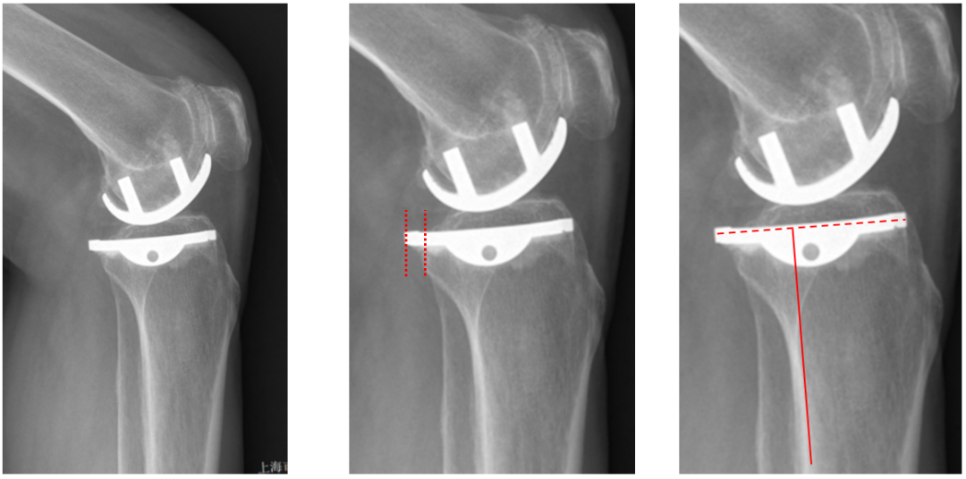 【读懂单髁】从读懂X-ray开始：固定平台单髁假体(LINK®