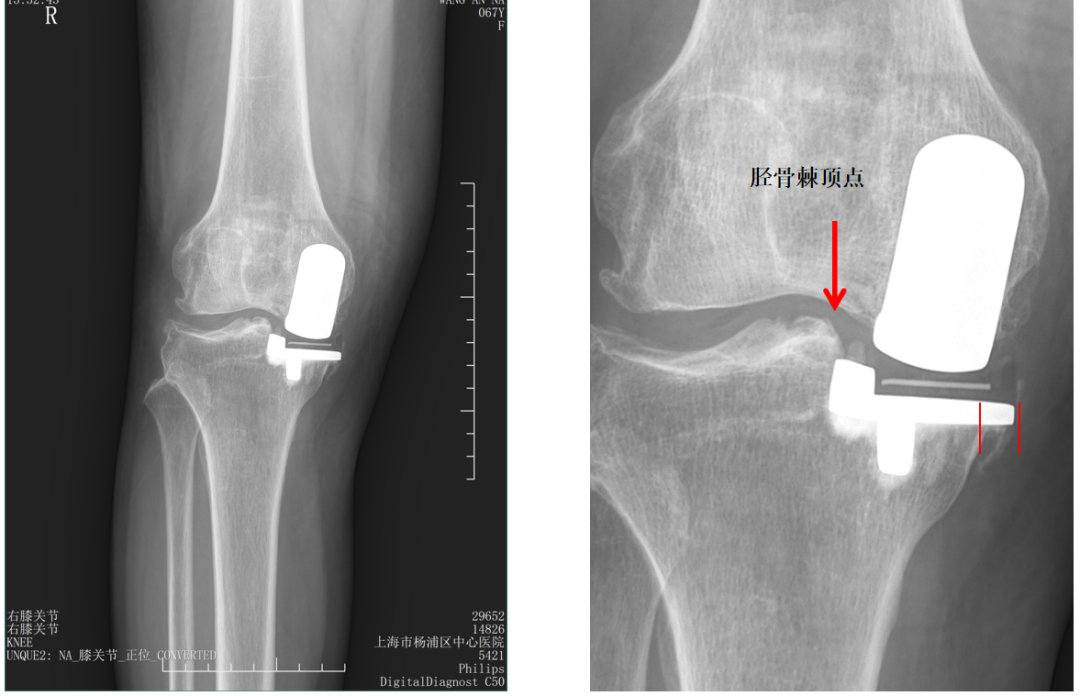 【读懂单髁】从读懂X-ray开始：胫骨假体位置解读