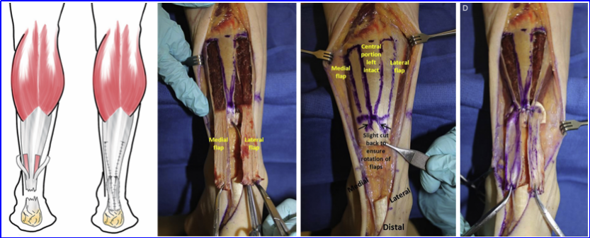 ​图文并茂：慢性跟腱断裂的最新治疗进展
