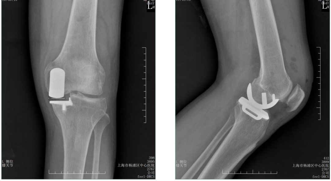 【读懂单髁】从读懂X-ray开始：胫骨假体位置解读