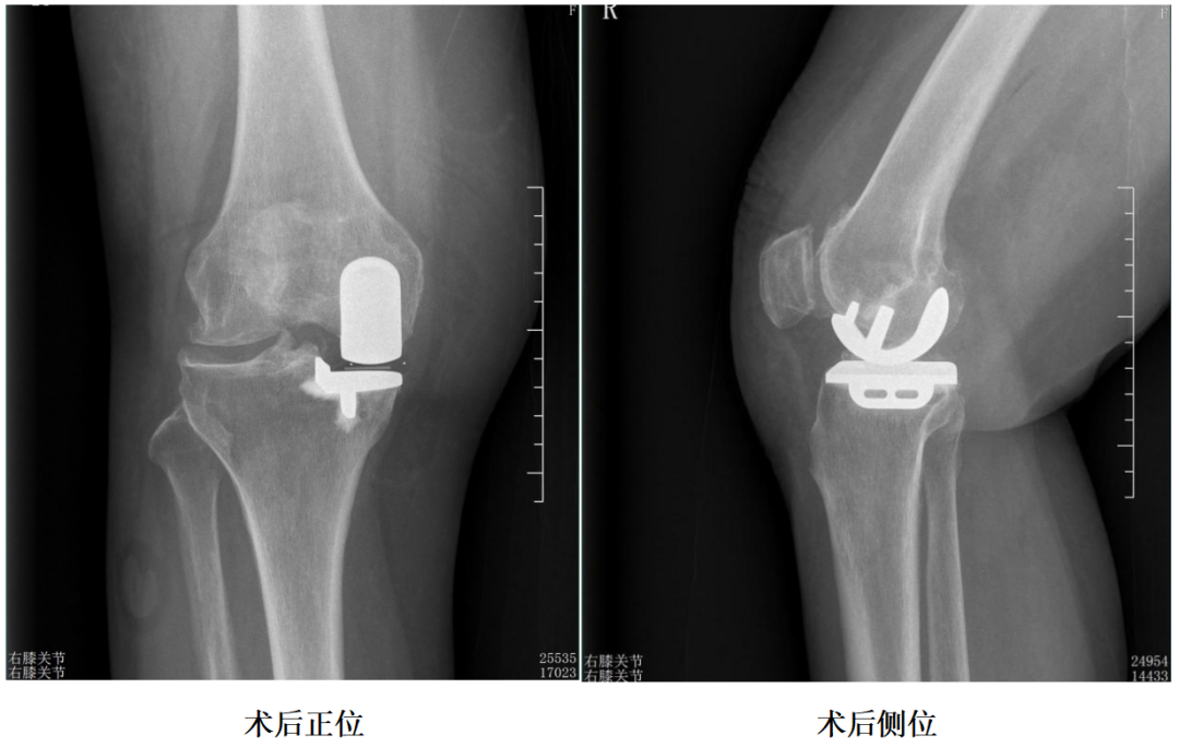 【手术视频】第二期：非髓腔依赖滑动平台单髁置换术