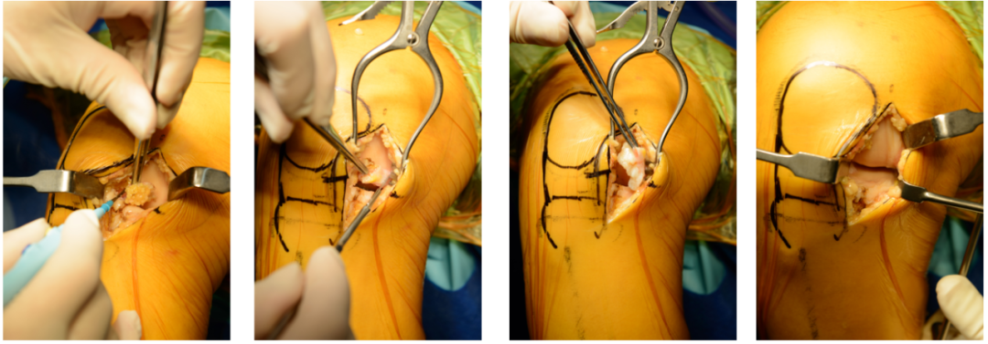 【滑动垫片单髁置换技术精讲系列】第一讲：麻醉、体位