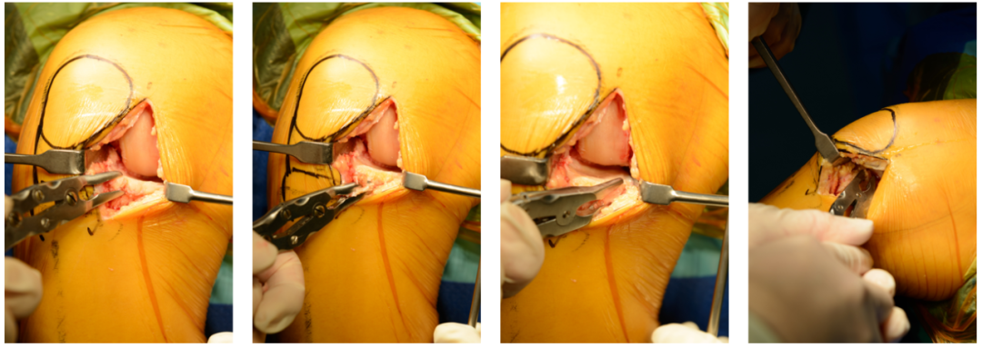 【滑动垫片单髁置换技术精讲系列】第一讲：麻醉、体位