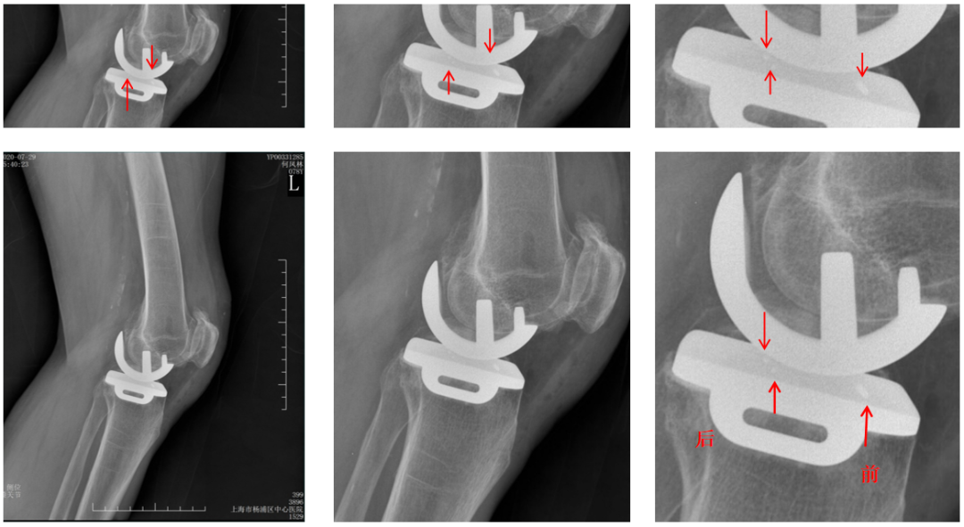 【读懂单髁】从读懂X-ray开始：术后摄片技术及垫片位置解读