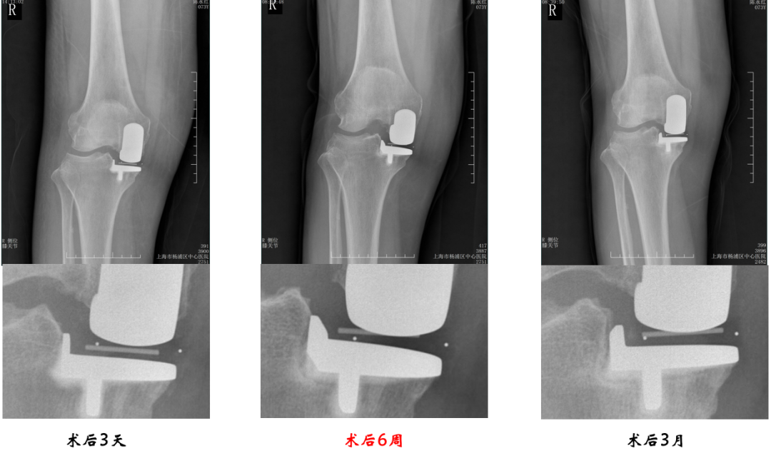 【读懂单髁】从读懂X-ray开始：胫骨假体位置解读