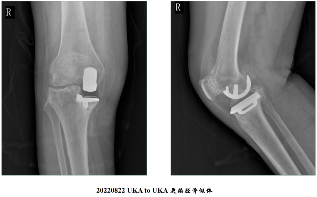 【读懂单髁】从读懂X-ray开始：胫骨假体位置解读