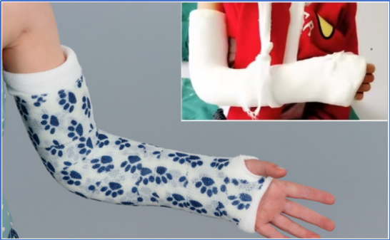 儿童肱骨外髁骨折的诊疗，本文全面总结！