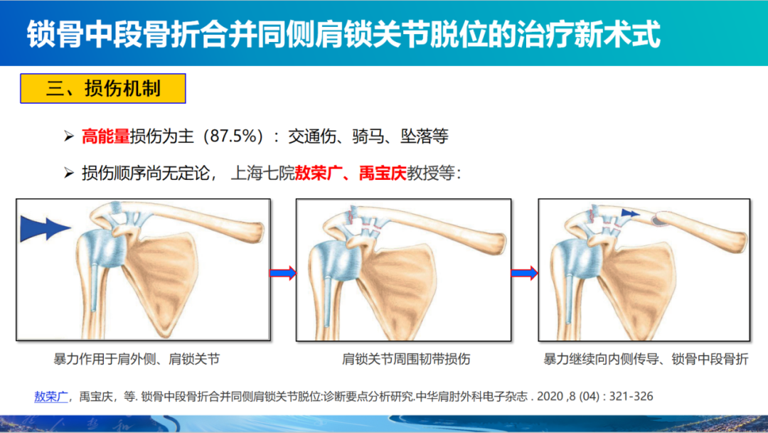 锁骨中段骨折合并同侧肩锁关节脱位新术式：弹性髓内钉+喙锁韧带重建、关节囊缝合