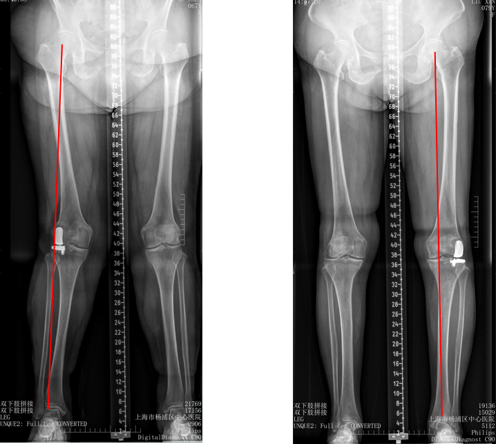 【读懂单髁】从读懂X-ray开始：固定平台单髁假体(LINK®