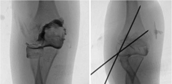 儿童肱骨外髁骨折的诊疗，本文全面总结！
