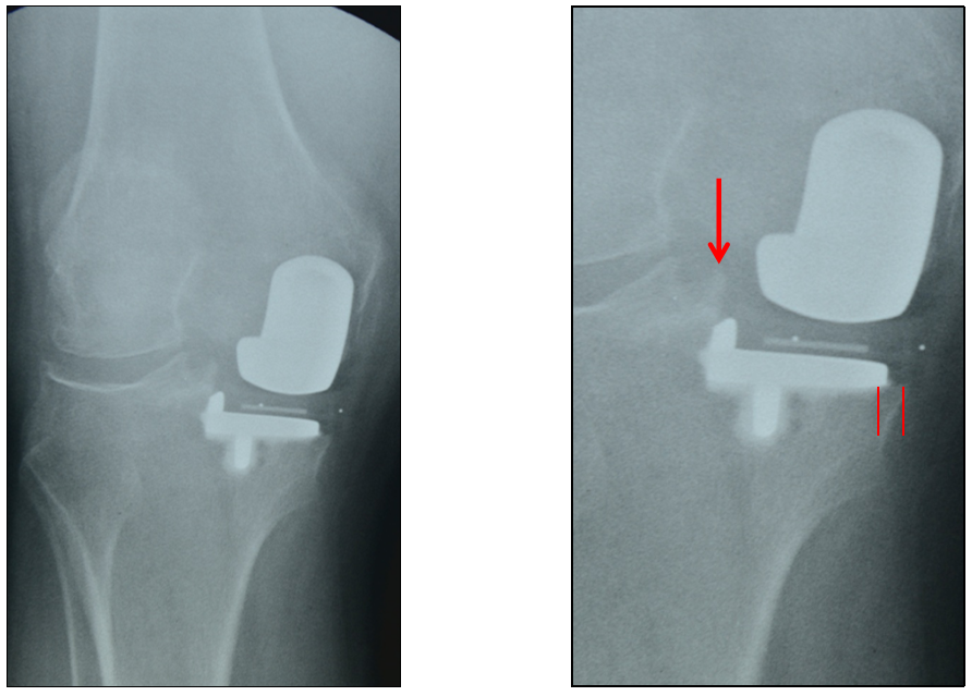 【读懂单髁】从读懂X-ray开始：胫骨假体位置解读