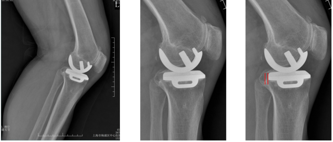 【读懂单髁】从读懂X-ray开始：胫骨假体位置解读