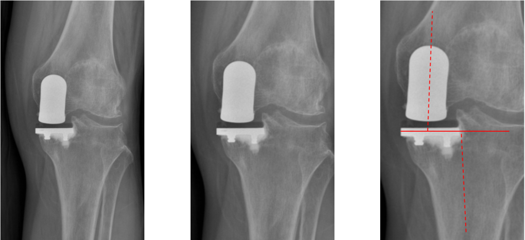 【读懂单髁】从读懂X-ray开始：固定平台单髁假体(SIGMA®