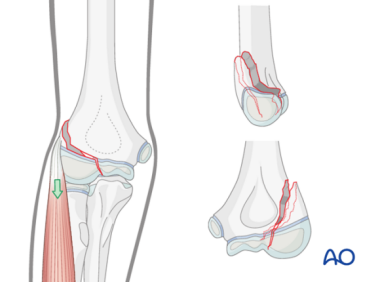 儿童肱骨外髁骨折的诊疗，本文全面总结！