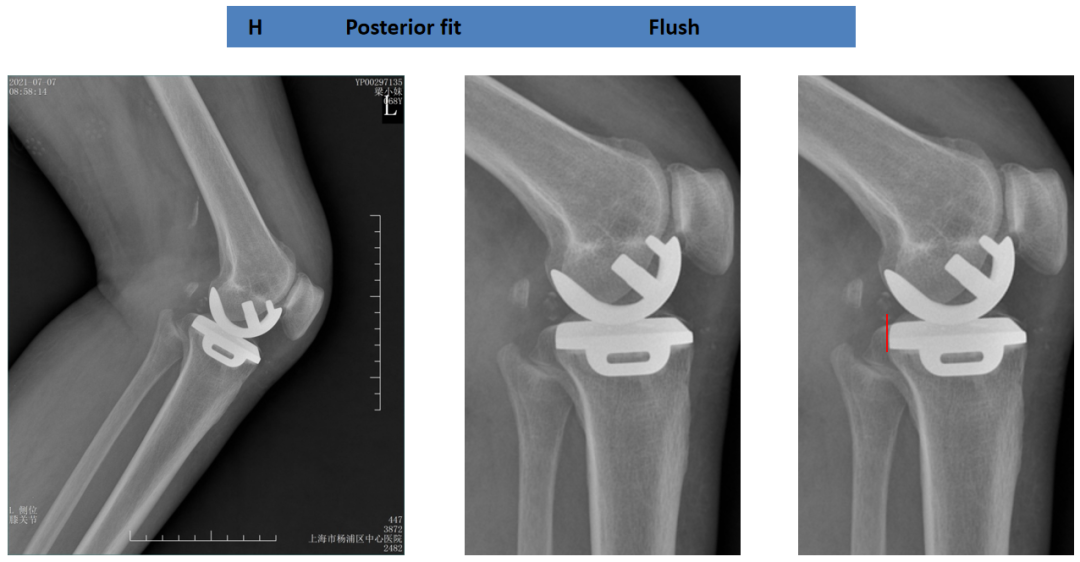 【读懂单髁】从读懂X-ray开始：胫骨假体位置解读