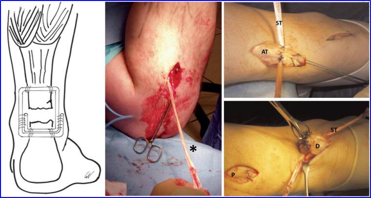 ​图文并茂：慢性跟腱断裂的最新治疗进展