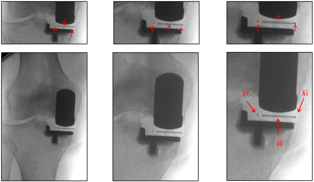 【读懂单髁】从读懂X-ray开始：术后摄片技术及垫片位置解读