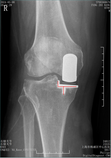 【读懂单髁】从读懂X-ray开始：术后摄片技术及垫片位置解读