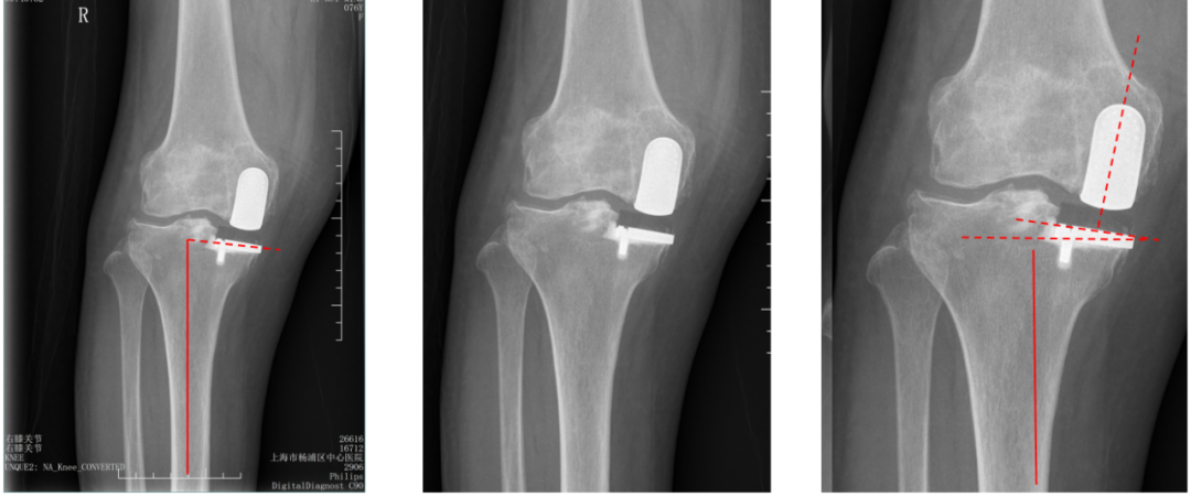 【读懂单髁】从读懂X-ray开始：固定平台单髁假体(LINK®