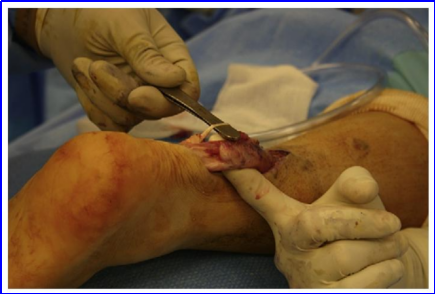 ​图文并茂：慢性跟腱断裂的最新治疗进展