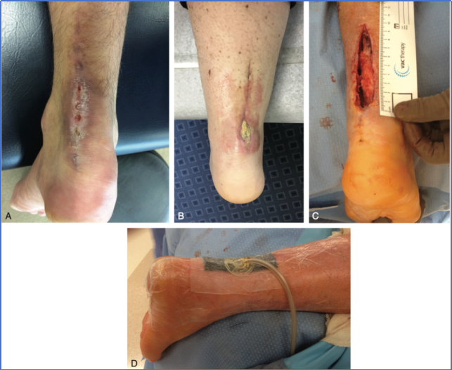 【手术技术】切开修复技术治疗急性跟腱断裂