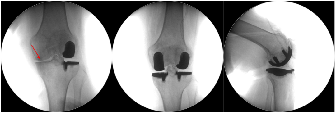 【读懂单髁】从读懂X-ray开始：固定平台单髁假体(LINK®
