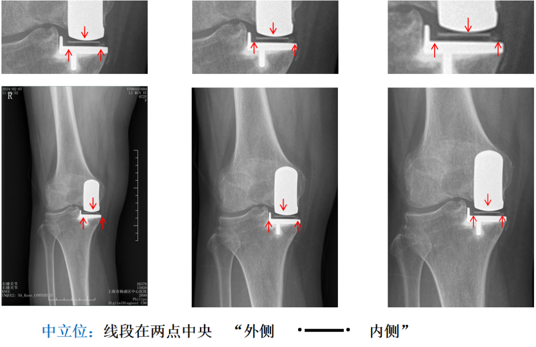 【读懂单髁】从读懂X-ray开始：术后摄片技术及垫片位置解读