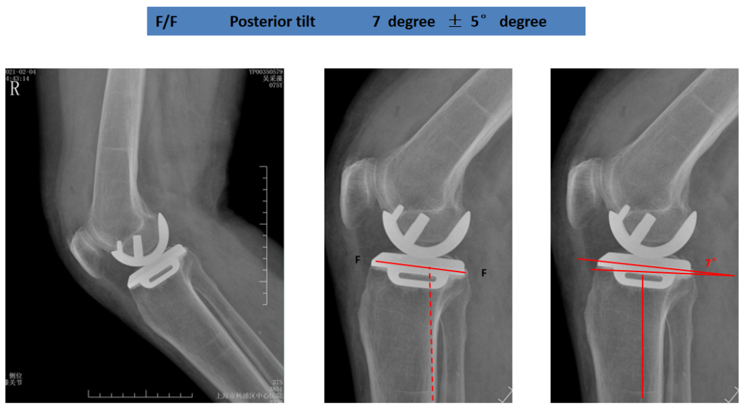 【读懂单髁】从读懂X-ray开始：胫骨假体位置解读
