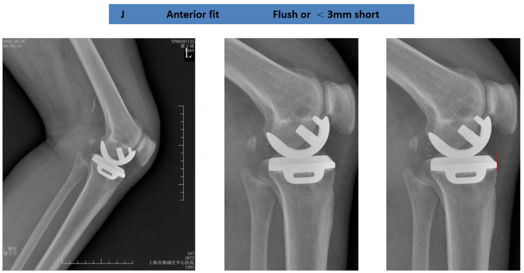 【读懂单髁】从读懂X-ray开始：胫骨假体位置解读