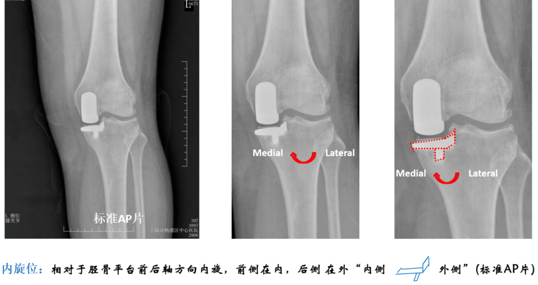 【读懂单髁】从读懂X-ray开始：胫骨假体位置解读