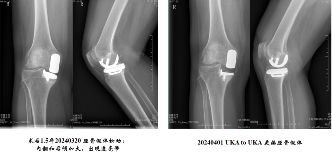 【读懂单髁】从读懂X-ray开始：胫骨假体位置解读