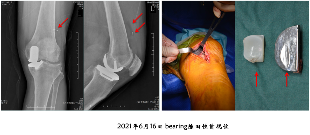 【读懂单髁】从读懂X-ray开始：术后摄片技术及垫片位置解读