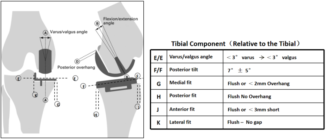 【读懂单髁】从读懂X-ray开始：胫骨假体位置解读