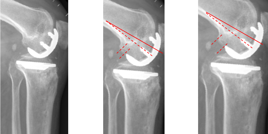 【读懂单髁】从读懂X-ray开始：固定平台单髁假体(SIGMA®