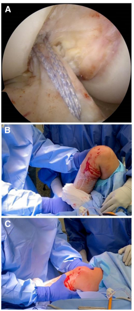 图文详解关节镜下如何实现对前交叉韧带近端撕裂的精准修复