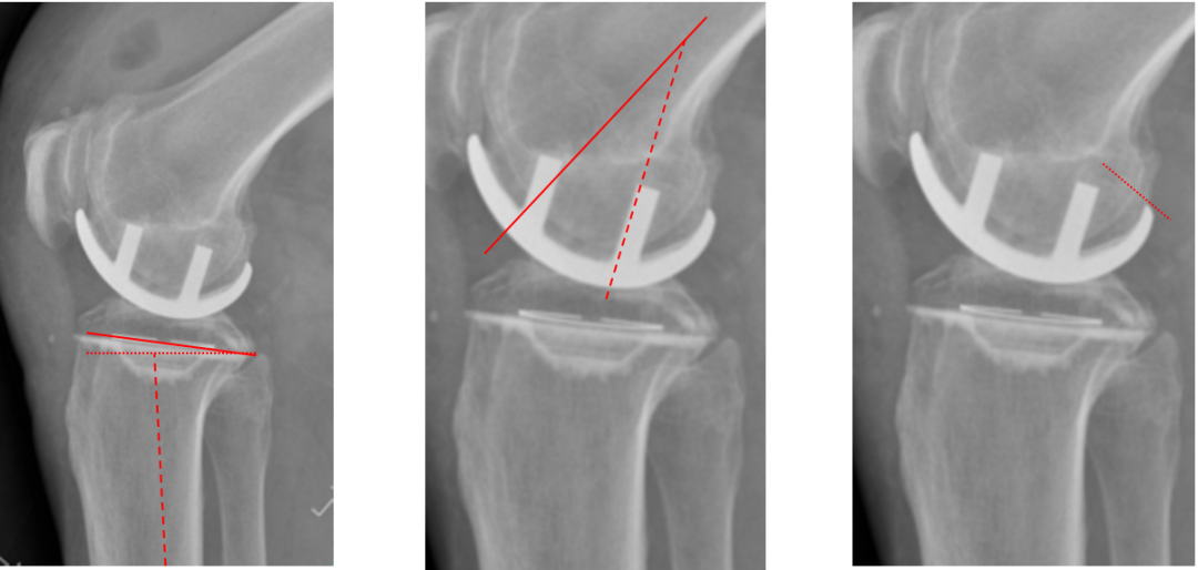 【读懂单髁】从读懂X-ray开始：固定平台单髁假体(LINK®