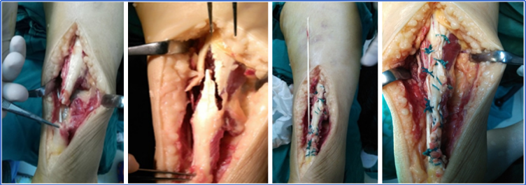 ​图文并茂：慢性跟腱断裂的最新治疗进展