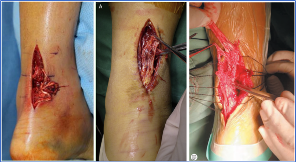 【手术技术】切开修复技术治疗急性跟腱断裂