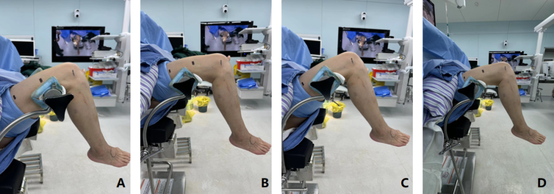 【滑动垫片单髁置换技术精讲系列】第一讲：麻醉、体位