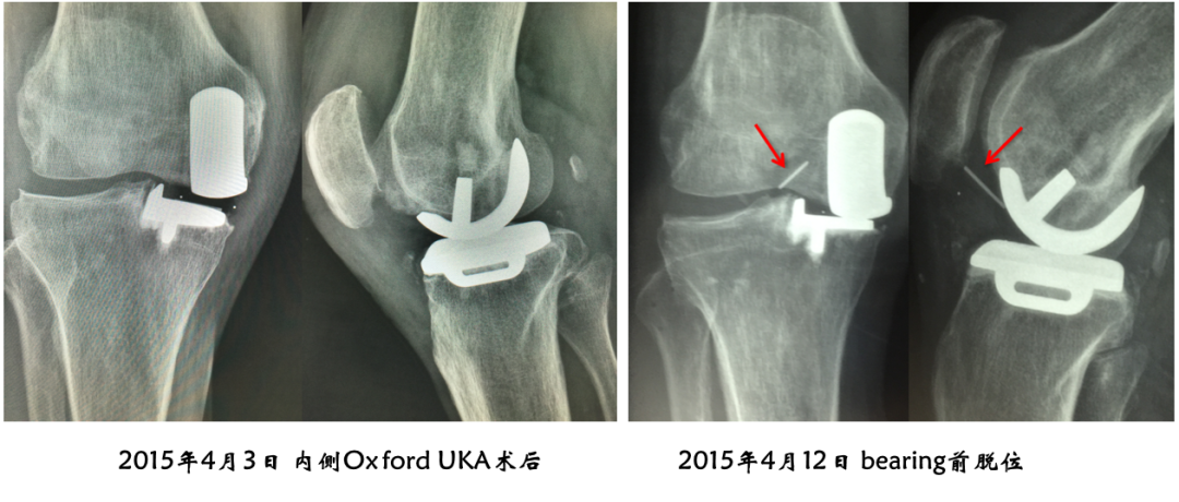 【读懂单髁】从读懂X-ray开始：术后摄片技术及垫片位置解读