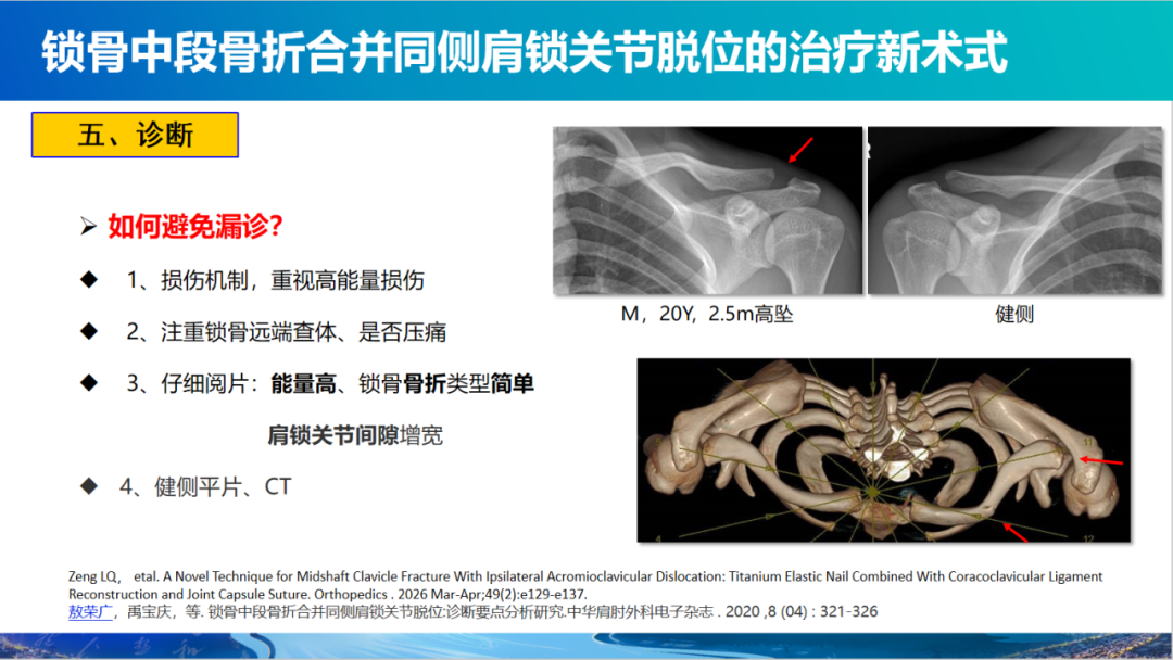 锁骨中段骨折合并同侧肩锁关节脱位新术式：弹性髓内钉+喙锁韧带重建、关节囊缝合